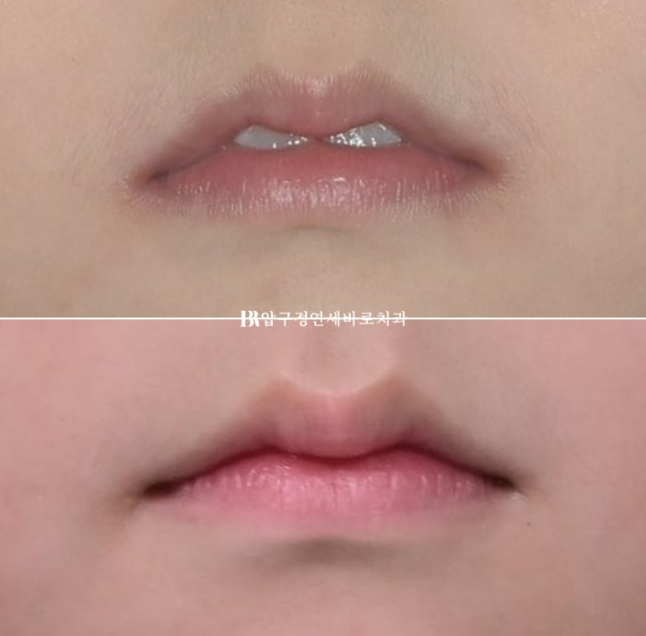 인비절라인 퍼스트, 결국 다시 교정해야 할까? 관련 이미지 17