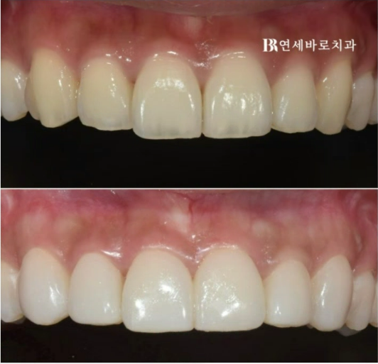 압구정 무삭제 라미네이트 가능할까? 관련 이미지 5