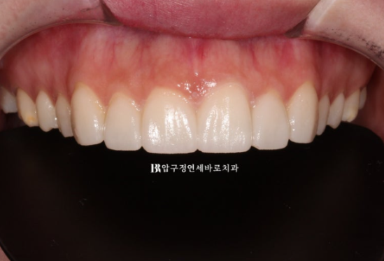 Non-Prep Veneer Review | A Case Naturally Improving Gaps Between the Front Teeth and the Smile Line image 7