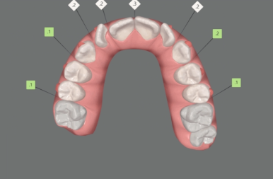 인비절라인라이트 덧니 과개교합 교정 치료기간 9개월 관련 이미지 6