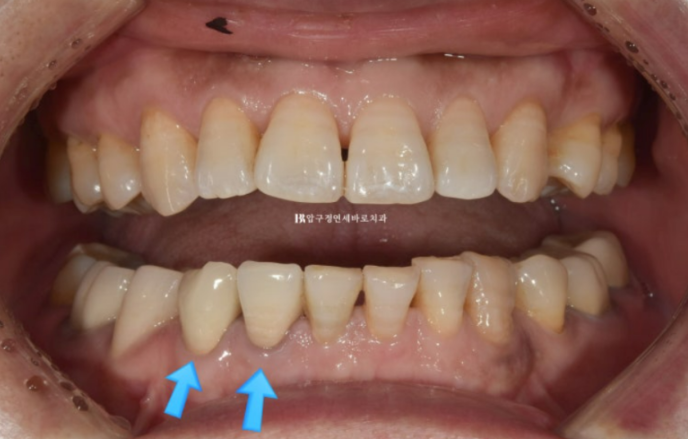 50대 라미네이트 삭제 없이 하는 법? 관련 이미지 1