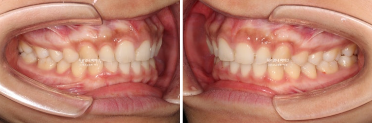 과개교합 옥니 거미스마일 교정 인비절라인 라이트 잇몸성형 후기 관련 이미지 13