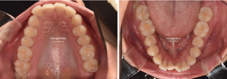 비발치 인비절라인 교정 돌출입 교정 후기 관련 이미지 4