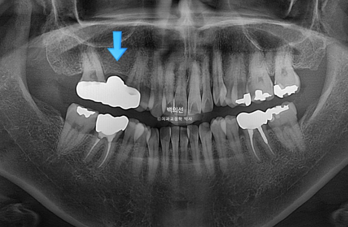 거미스마일 교정 돌출입 발치교정 입술부전 호두턱 치료기간 2년반 관련 이미지 9