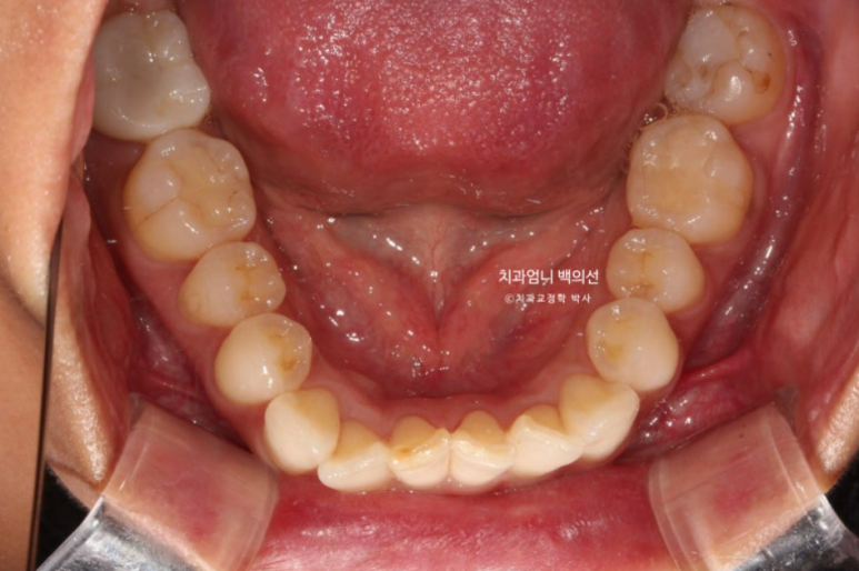 인비절라인 비발치 덧니 교정 반대교합 치료 후기 관련 이미지 5