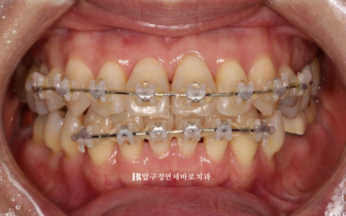 Orthodontics in Your 40s: Worried Your Gums Will Recede? | A 6-Month Front Teeth Partial Orthodontic Case That Also Improved Black Triangles image 5