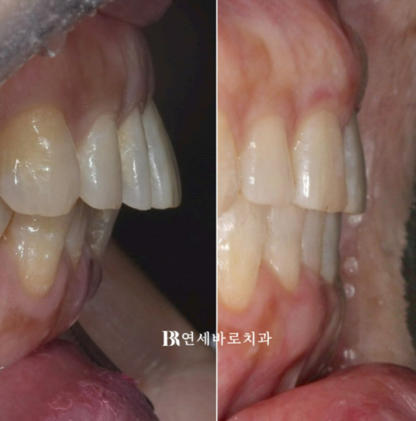 50대 60대 중년 치아 벌어짐 단기 교정 해결하기 관련 이미지 6