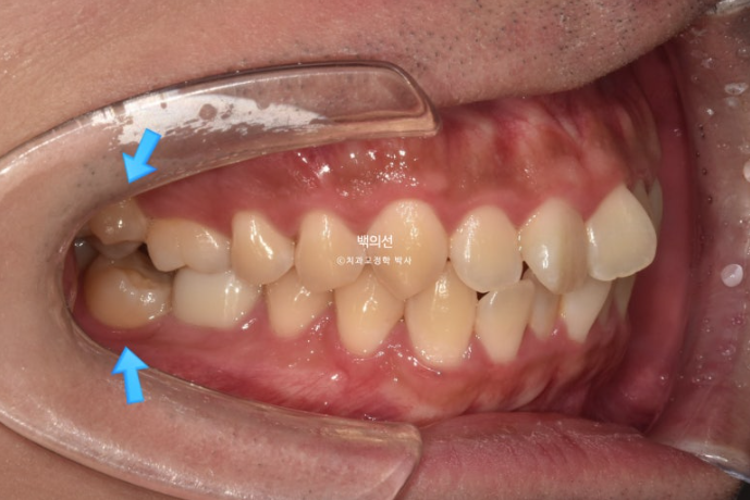 가위교합 나비치아 미니스크류 덧니 교정 인비절라인 라이트 관련 이미지 4