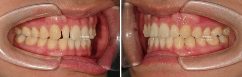옥니 덧니 교정 왜소치 선천적 결손 3전치 무삭제 라미네이트 인비절라인 교정 관련 이미지 13