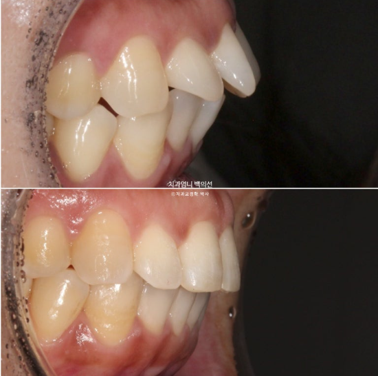 40대 인비절라인 라이트 앞니 벌어짐 뻗침 돌출 치료 관련 이미지 18