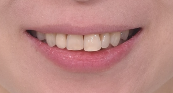 40대 인비절라인 라이트 가위교합? 관련 이미지 2