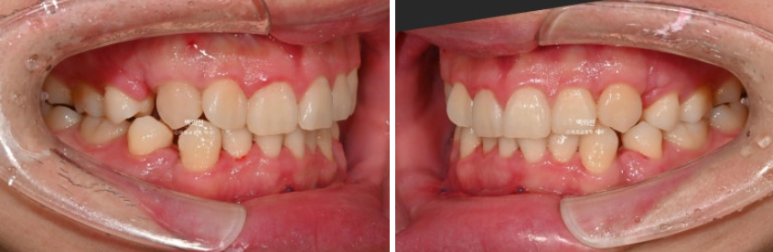돌출입 수술 ASO + 인비절라인 라이트 후교정 치료기간 10개월 관련 이미지 3