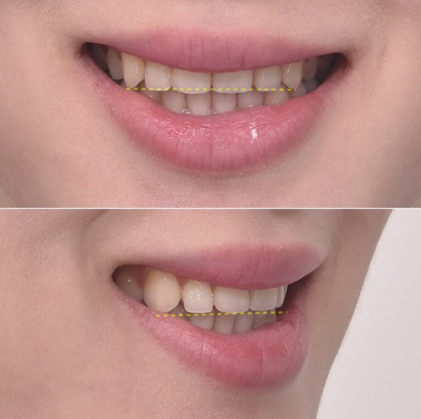 Before and After Non-Prep Veneers: Improving Gaps Between the Front Teeth and the Smile Line Together image 5