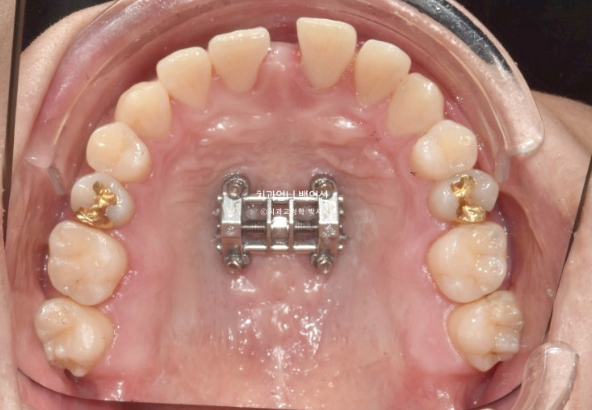 MSE Palatal Expansion Invisalign Underbite Correction, Non-Surgical image 9