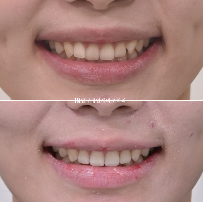 압구정 교정치과 / 옥니교정 인비절라인 라이트 덧니교정 관련 이미지 16