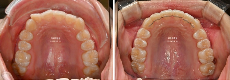 덧니 인비절라인 라이트 잇몸미소 거미스마일 중심선 블랙트라이앵글 관련 이미지 14
