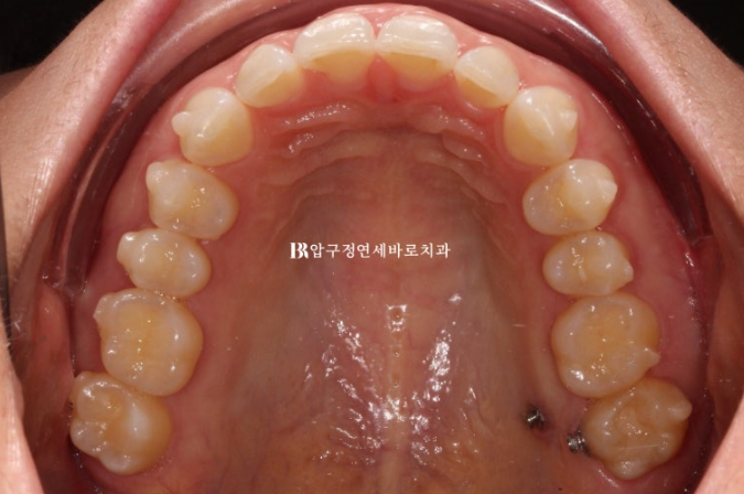 인비절라인 라이트 가위교합 벌어짐 중심선 미니스크류 치료기간 11개월 관련 이미지 7