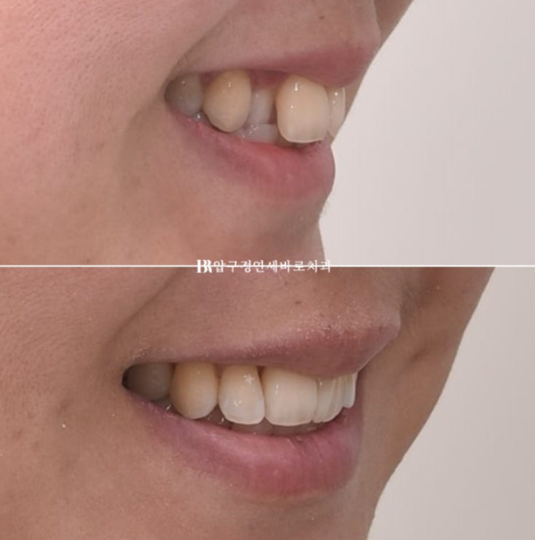 예비신부 교정 단기 앞니 부분교정 치료기간 6개월 관련 이미지 16