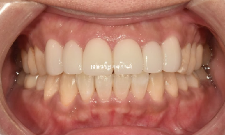 40대 치아교정 인비절라인 라이트 덧니 교정 어금니 교합 부작용 관련 이미지 12