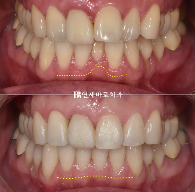 안보이는 앞니 교정 2D 교정 부분교정 후기 / 교정 시 잇몸이 더 나빠지지 않을까요? 관련 이미지 6