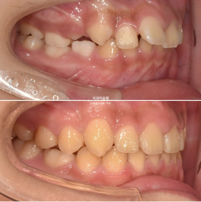 선천적 결손 잔존유치 과개교합 돌출입 인비절라인 퍼스트 어린이 투명교정 치료기간 관련 이미지 21