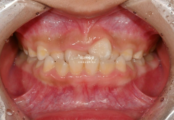 7세 어린이 반대교합 부정교합 프리올소 치료 관련 이미지 2