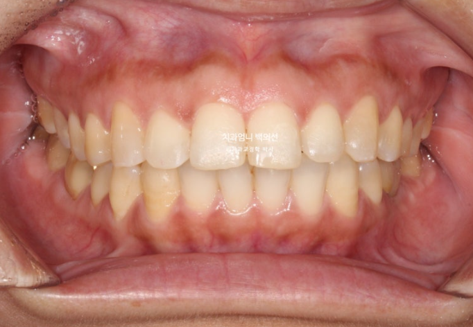 40대 인비절라인 라이트 앞니 벌어짐 뻗침 돌출 치료 관련 이미지 13