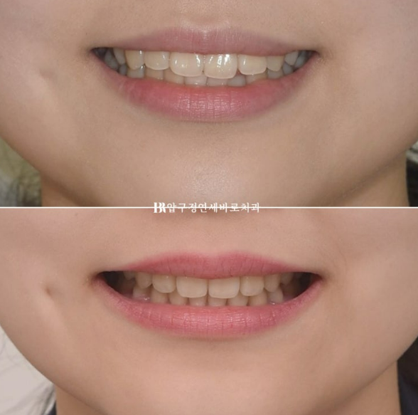 돌출입 교정 후 입매 변화, 과하지 않게 자연스럽게 관련 이미지 1