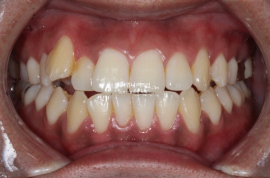 반대교합 비발치 교정 클리피씨 후기 관련 이미지 2