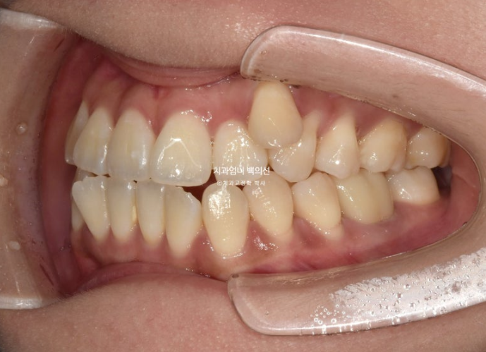 비발치 교정 덧니 인비절라인 교정 절단교합 반대교합 치료기간 1년 6개월 관련 이미지 5