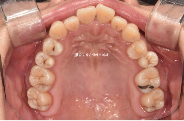 Is compliance important for Invisalign? | A real case that improved reverse bite and scissors bite in 8 months image 4