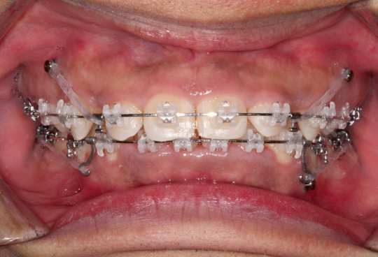 거미스마일 잇몸미소 발치 돌출입 과개교합 교정 후기 관련 이미지 5