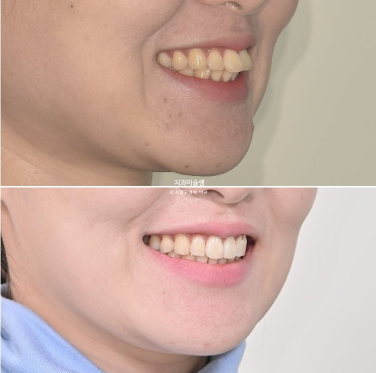 비발치 돌출입 인비절라인 교정 가위교합 중심선 맞추기 관련 이미지 25