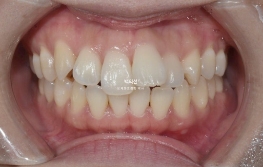 30대 돌출입 덧니 교정 인비절라인 발치교정 후기 관련 이미지 2