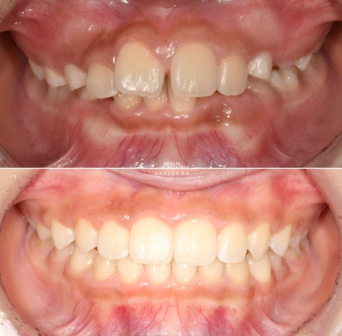 인비절라인퍼스트 어린이 투명교정 과개교합 덧니 악궁확장 돌출 관련 이미지 20