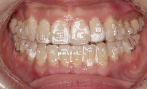 Is Invisalign Treatment Possible After Double-Jaw Surgery? A Real One-Year Case of Surgery-First Orthodontic Treatment image 8