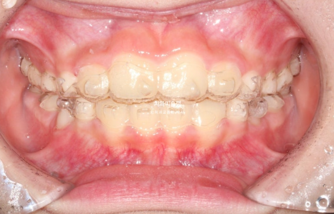 어린이 투명교정 인비절라인 퍼스트 과개교합 교정 후기 관련 이미지 12