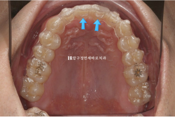 돌출입 인비절라인 교정 과개교합 교정 관련 이미지 4