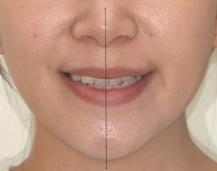 비발치 교정 덧니 인비절라인 교정 절단교합 반대교합 치료기간 1년 6개월 관련 이미지 3