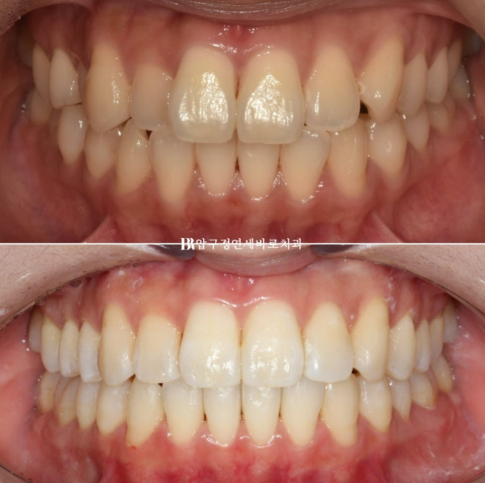 Invisalign Lite Treatment for Crossbite, Rabbit Teeth, and Protruding Front Teeth Correction image 1