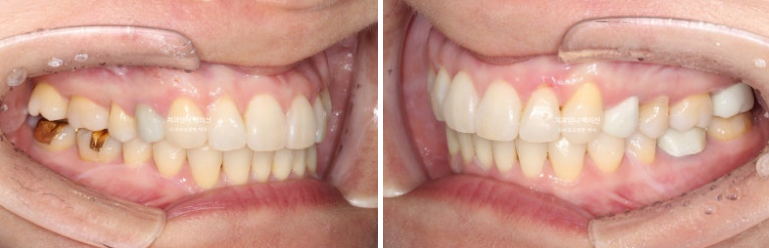 50대 캔팅 교합평면 기울어짐 덧니 교정 인비절라인 라이트 교정? 관련 이미지 9