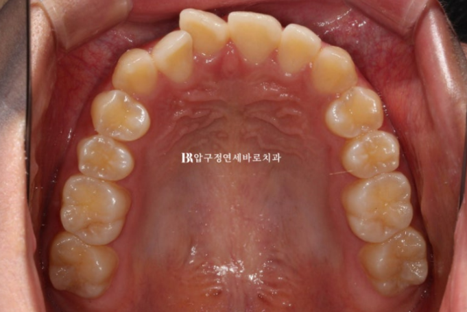 압구정 교정치과 덧니 부분교정 단기교정 후기 관련 이미지 3