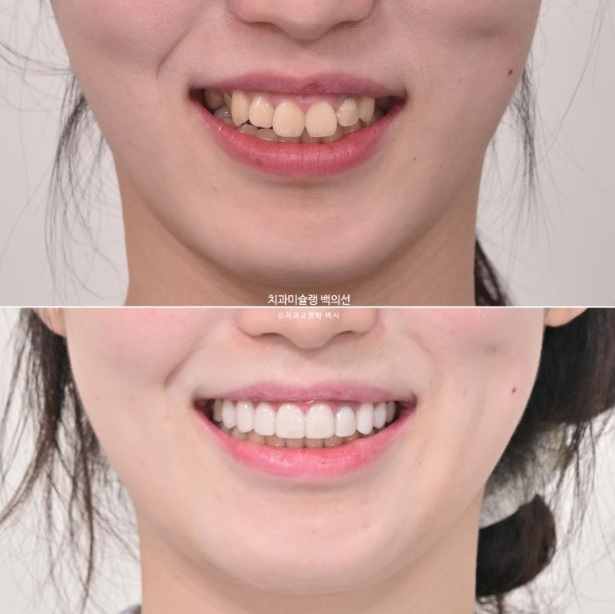 잇몸미소 인비절라인 거미스마일 토끼이빨 교정 무삭제 라미네이트 반대교합 치료 후기 관련 이미지 20