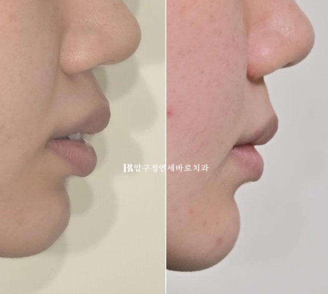 Gummy Smile Correction, Gummy Smile Orthodontics, Rabbit Teeth Correction image 17