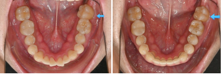 가위교합 벌어짐 중심선 과개교합 인비절라인 라이트 교정 관련 이미지 15