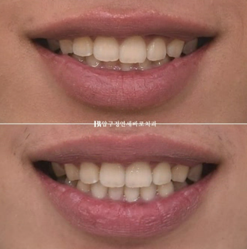 압구정 인비절라인 라이트 과개교합 후기 관련 이미지 12