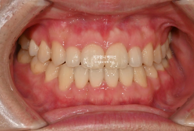 주걱턱 교정 반대교합 소구치 선천적 결손 부정교합 비발치 교정 후기 관련 이미지 9