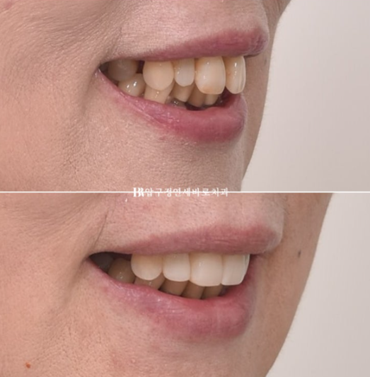 A 60s Patient’s Orthodontic Treatment Review | A Case Combining Partial Orthodontics for the Front Teeth After Periodontitis Treatment with No-Prep Veneers image 8