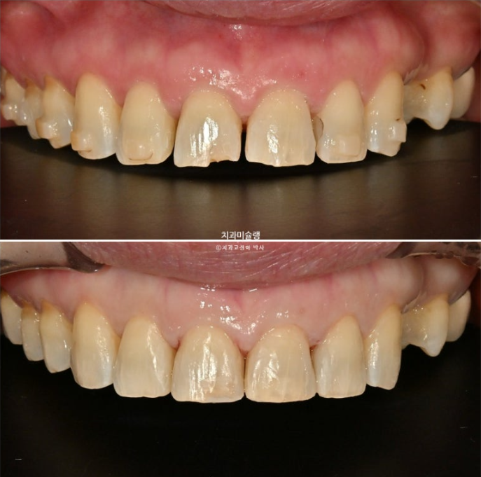 50대 치아교정 돌출 치아벌어짐 중년교정 관련 이미지 11