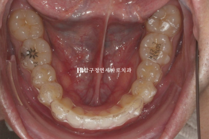 돌출입 인비절라인 교정 과개교합 교정 관련 이미지 3